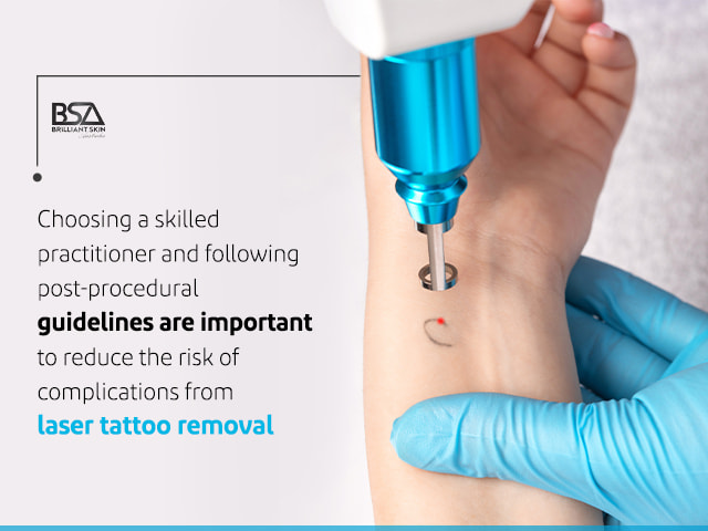 Laser Tattoo Removal | Almeka Medical Centre