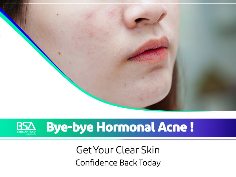 hormonal acne