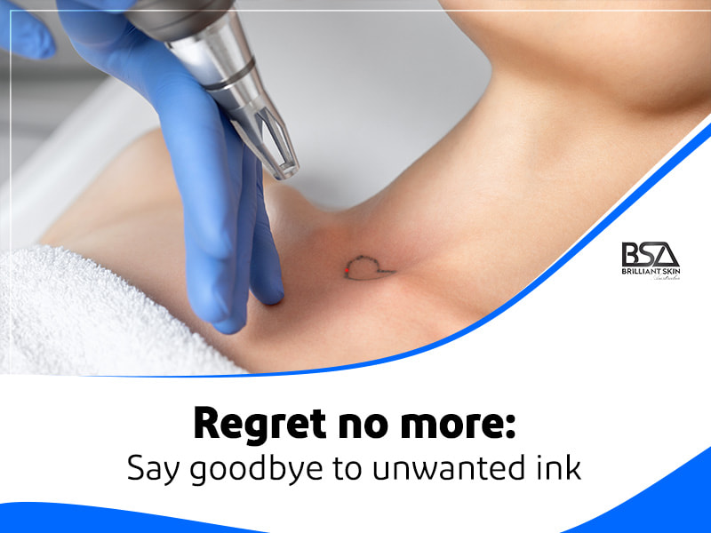 Regret no more Say goodbye to unwanted ink