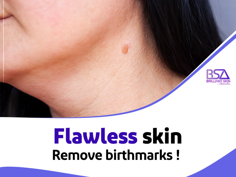 Remove birthmarks