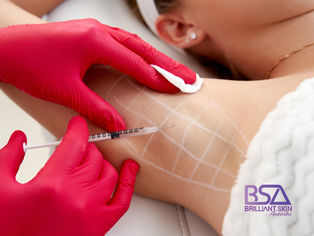 Underarm antiperspirant injection