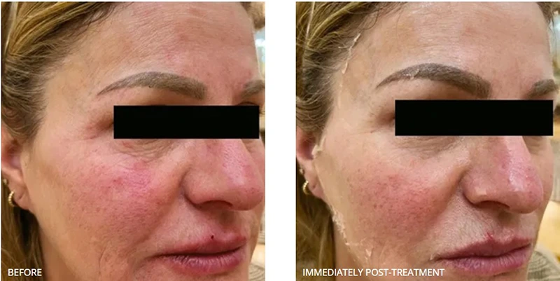 Before and immediately after CO₂ Lift PRO Carboxy Therapy showing reduced redness and smoother skin texture.