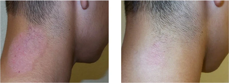 Before and after CO₂ Lift PRO Carboxy Therapy showing improvement in redness and skin tone on the neck area.