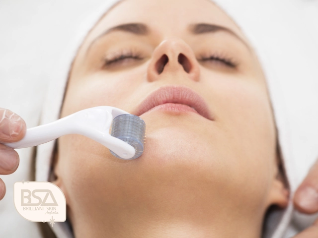 Microneedling derma roller applied to chin during treatment