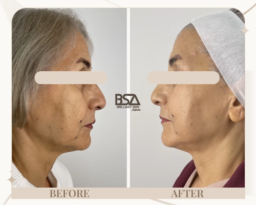 Radio frequency treatment before and after for skin firmness improvement