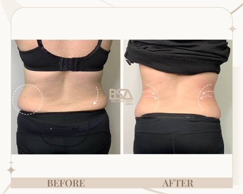 Body sculpting before and after showing reduced lower back fat