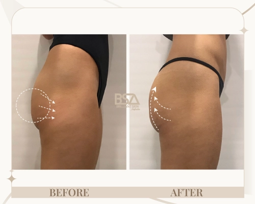 Body sculpting before and after showing improved outer thigh contour