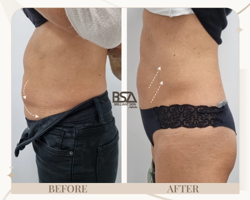 Body sculpting before and after showing slimmer waistline