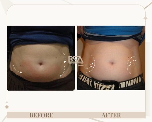 Body sculpting before and after showing improved stomach contour