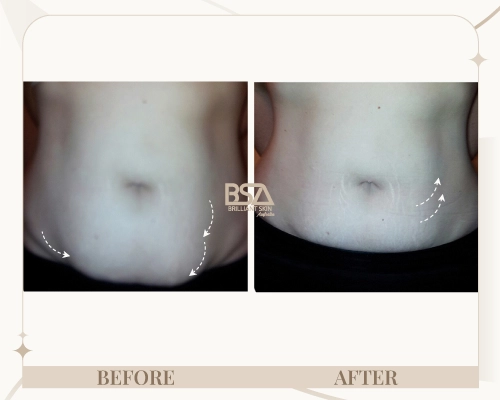 Body sculpting before and after showing lower abdomen fat reduction