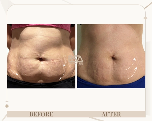 Body sculpting before and after showing postpartum abdominal tightening