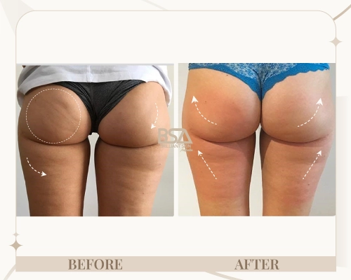 Body sculpting before and after showing lifted buttocks and smoother thighs