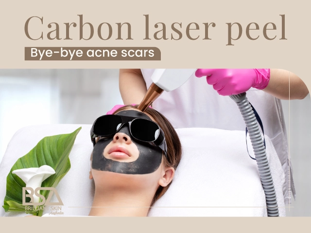 Carbon laser peel treatment targeting acne scars