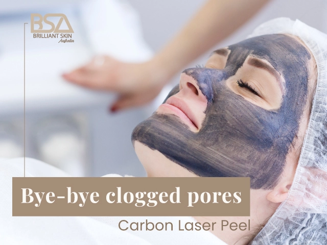 Carbon laser peel treatment helping to unclog pores