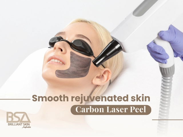 Carbon laser peel treatment rejuvenating facial skin
