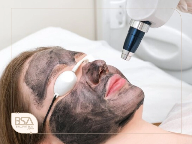 Laser device activating carbon mask during carbon laser peel