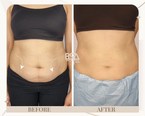 Fibroblast plasma treatment before and after showing abdominal skin tightening