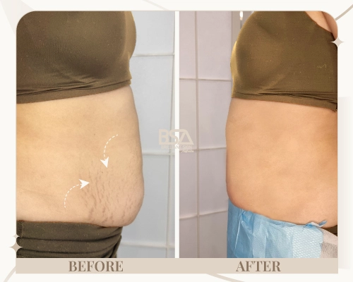Fibroblast plasma before and after showing reduced loose abdominal skin