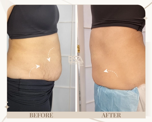 Side profile before and after showing abdominal skin tightening from fibroblast treatment