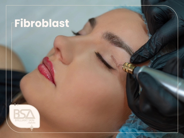 Fibroblast plasma pen tightening treatment on upper eyelid